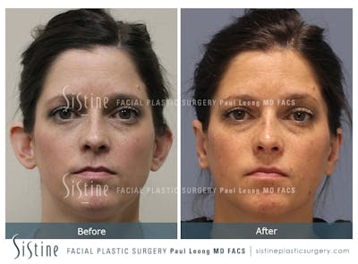 Otoplasty Before & After Gallery - Patient 168575 - Image 1