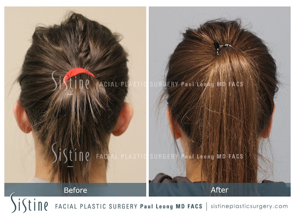 Otoplasty Before & After Gallery - Patient 168575 - Image 2
