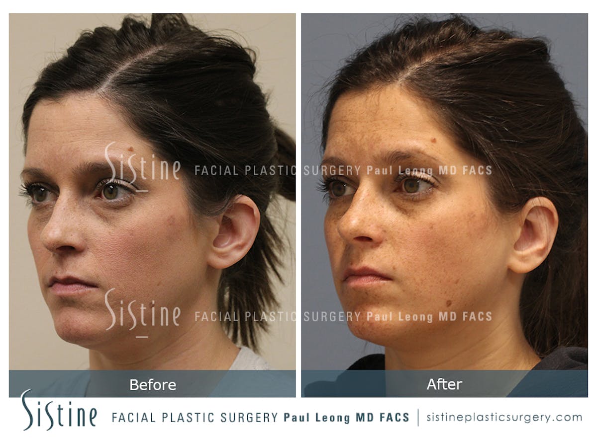 Otoplasty Before & After Gallery - Patient 168575 - Image 3