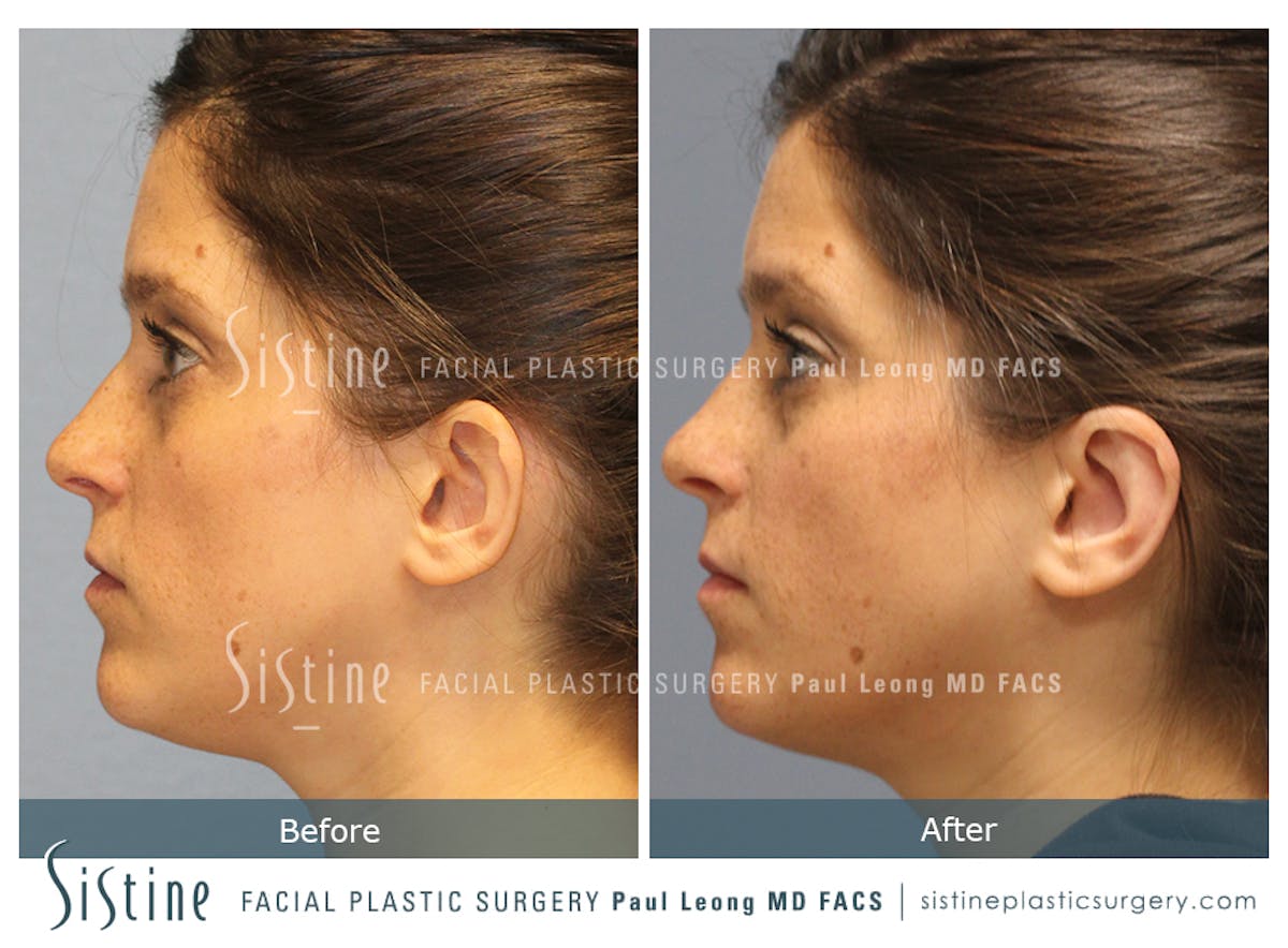 Otoplasty Before & After Gallery - Patient 168575 - Image 4