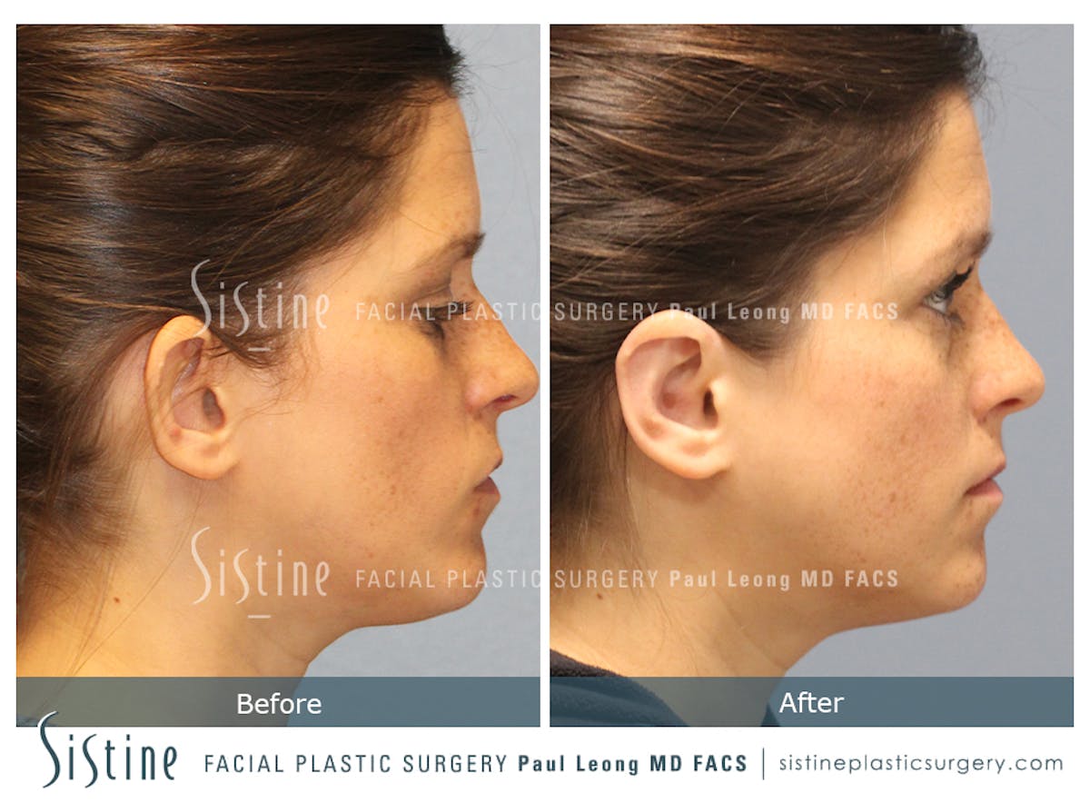 Otoplasty Before & After Gallery - Patient 168575 - Image 5