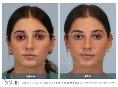 Rhinoplasty Before & After Gallery - Patient 150221 - Image 1