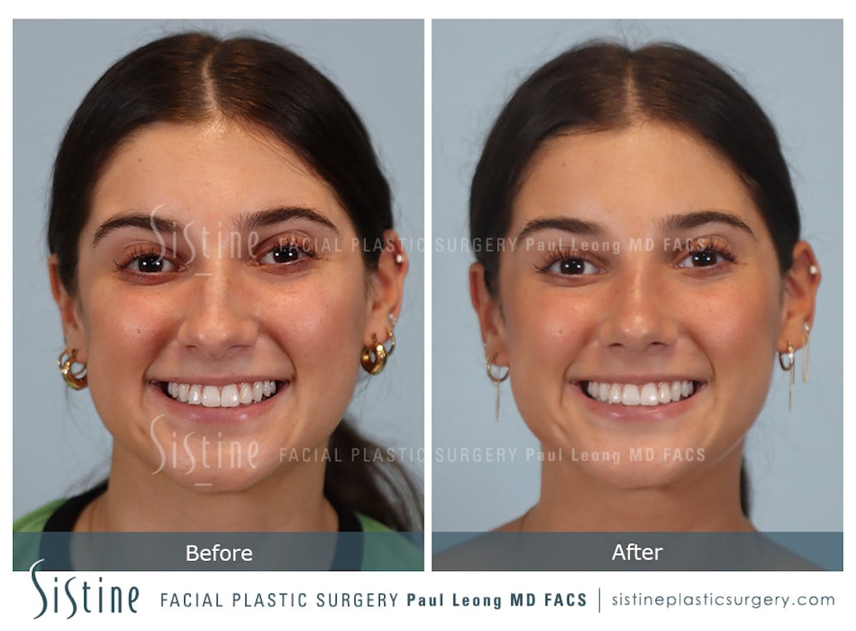 Rhinoplasty Before & After Gallery - Patient 150221 - Image 2