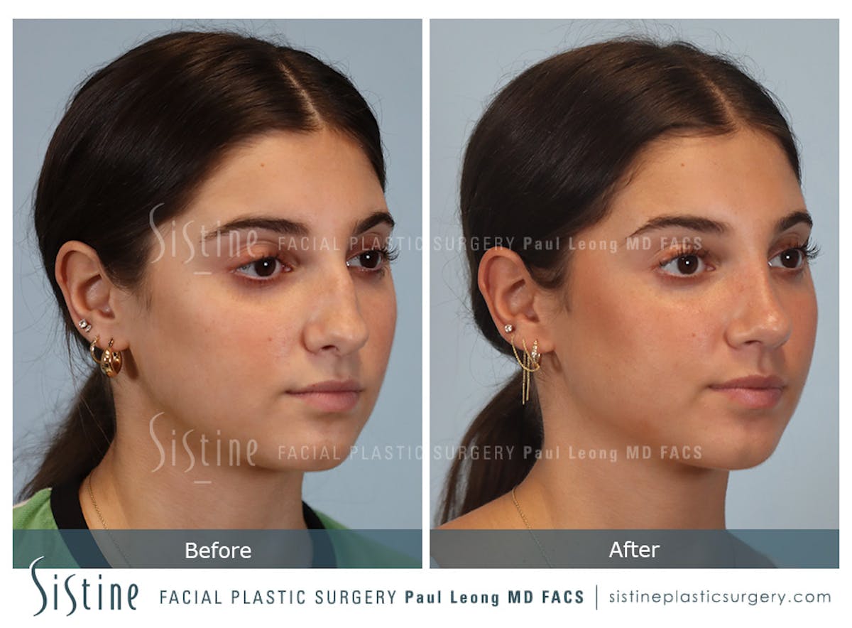 Rhinoplasty Before & After Gallery - Patient 150221 - Image 3