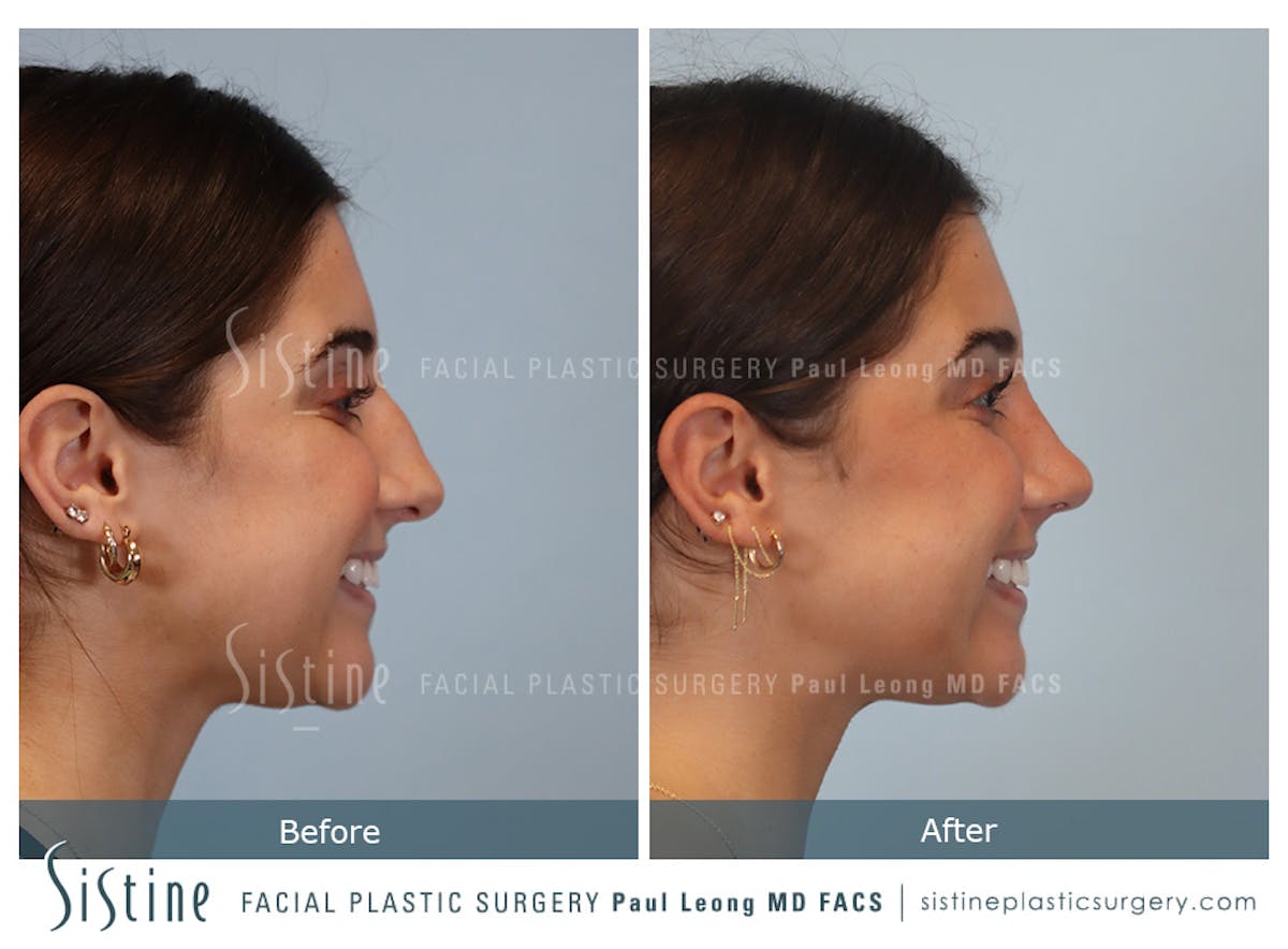 Rhinoplasty Before & After Gallery - Patient 150221 - Image 5