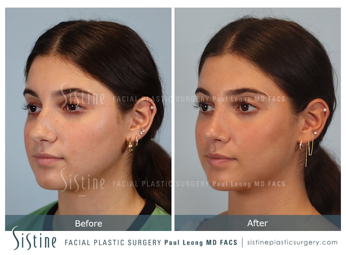 Rhinoplasty Before & After Gallery - Patient 150221 - Image 6