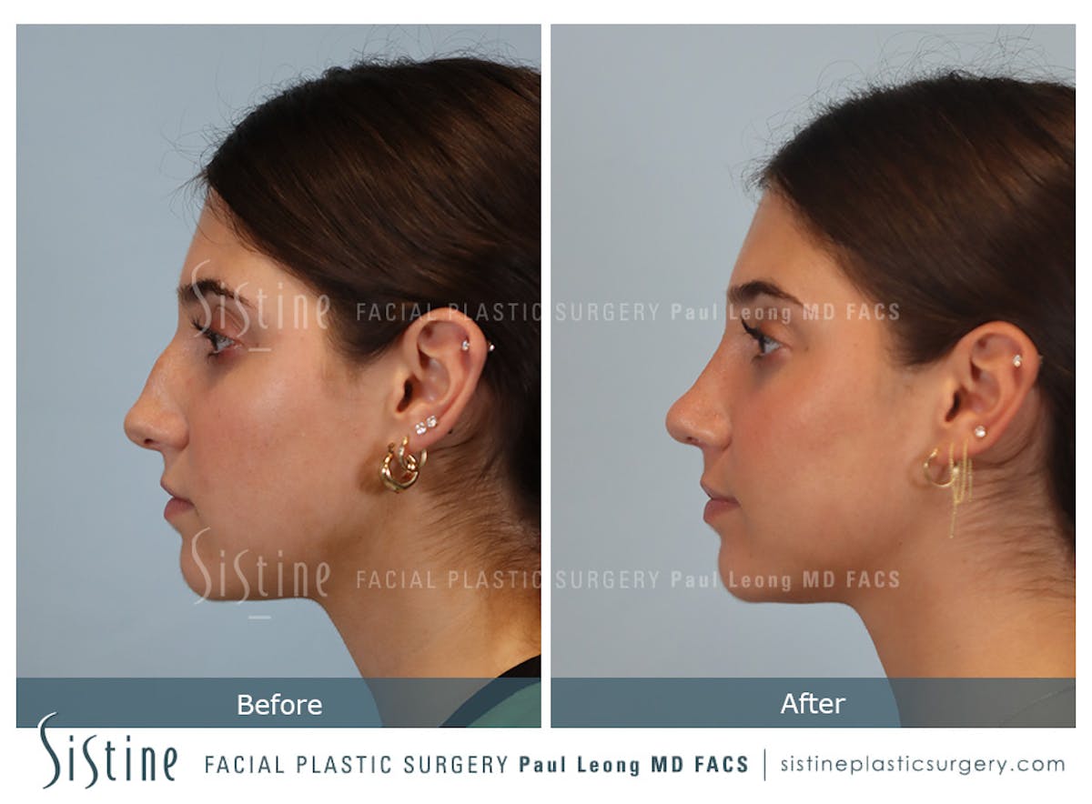 Rhinoplasty Before & After Gallery - Patient 150221 - Image 7