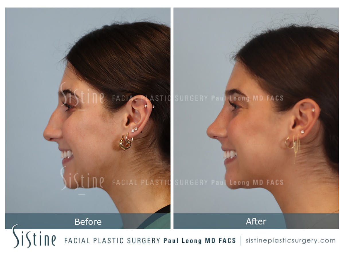 Rhinoplasty Before & After Gallery - Patient 150221 - Image 8