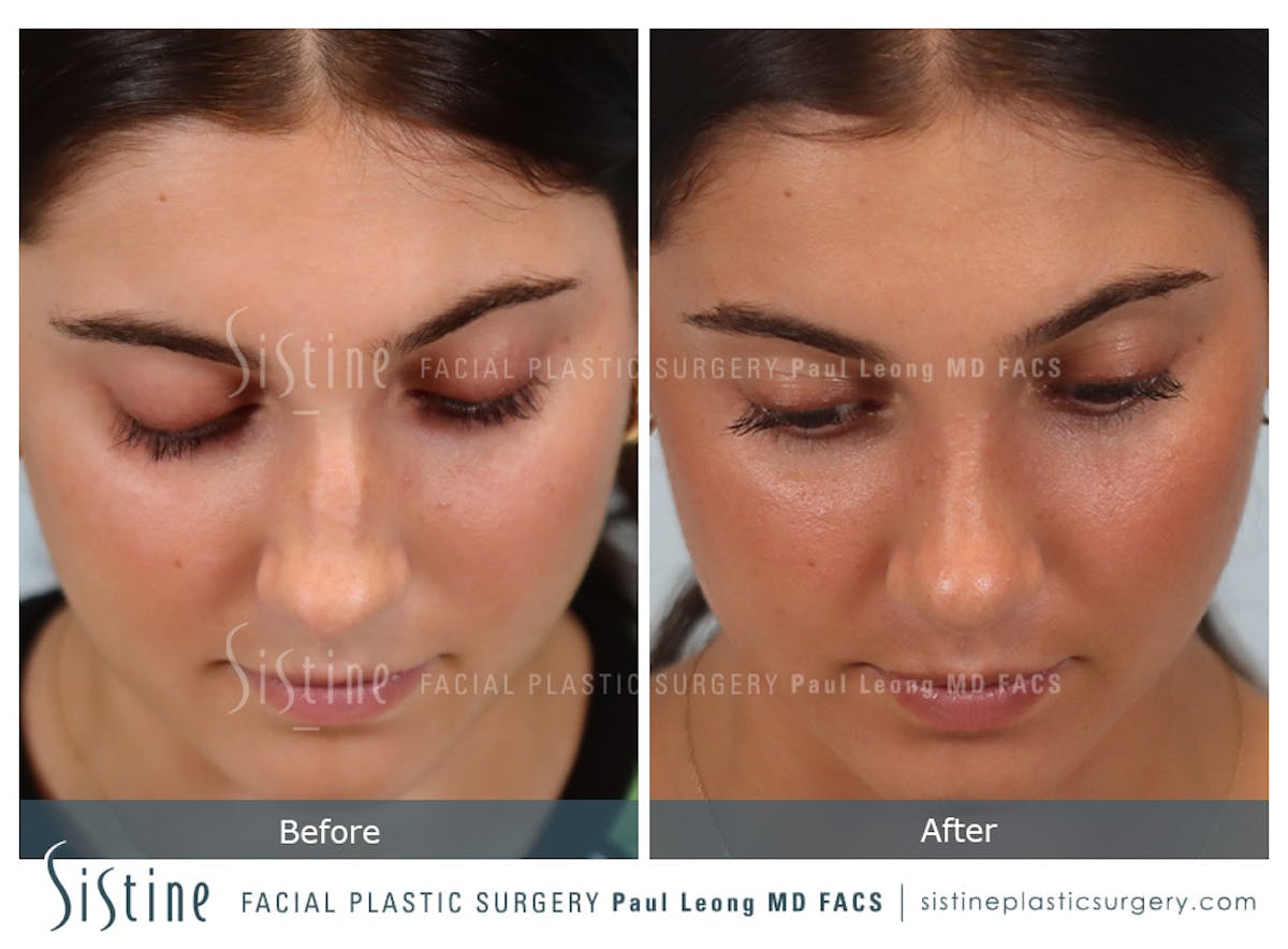 Rhinoplasty Before & After Gallery - Patient 150221 - Image 9