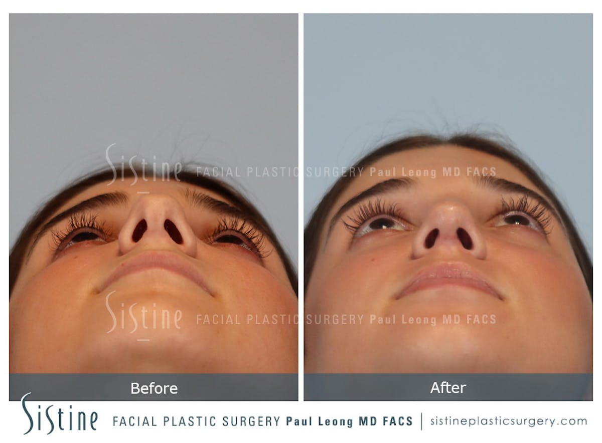 Rhinoplasty Before & After Gallery - Patient 150221 - Image 10