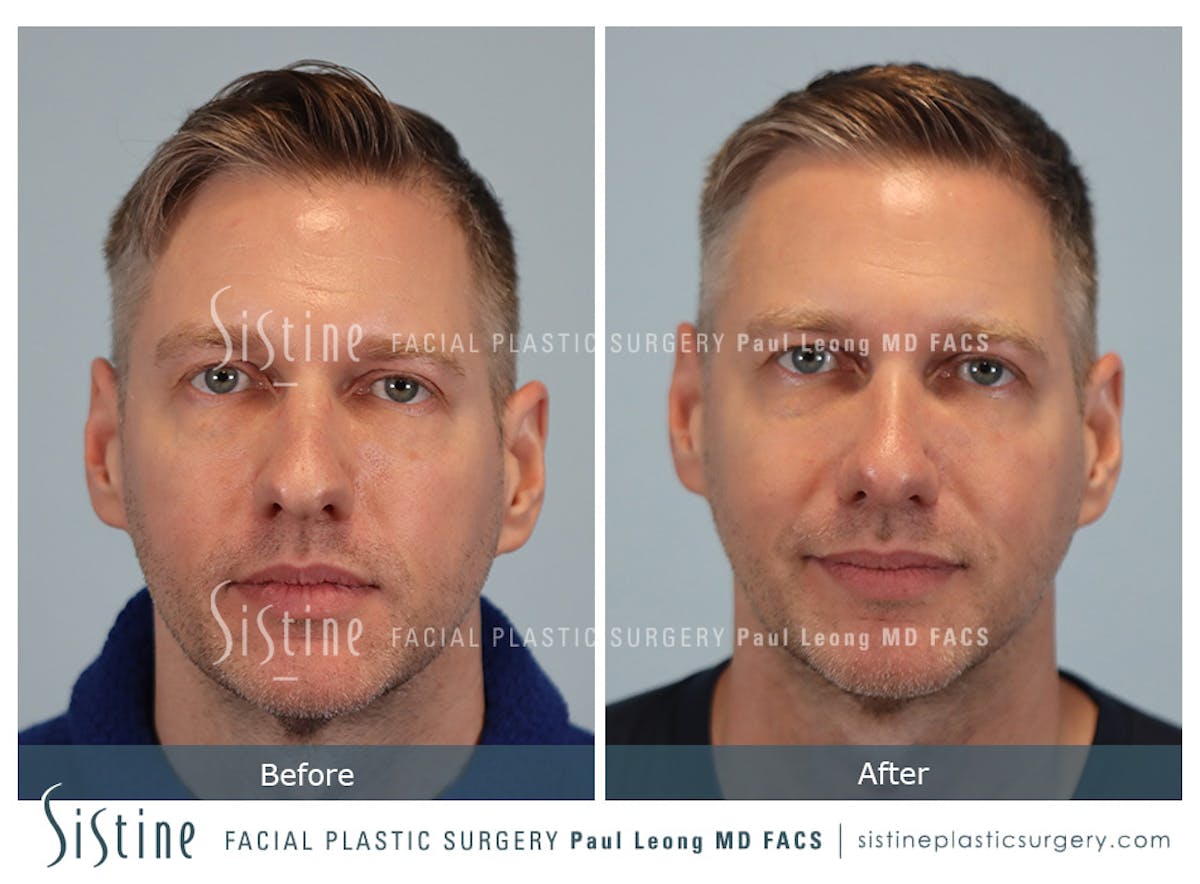 Rhinoplasty Before & After Gallery - Patient 103732 - Image 1