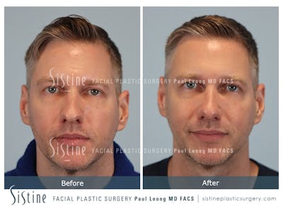 Rhinoplasty Before & After Gallery - Patient 103732 - Image 1