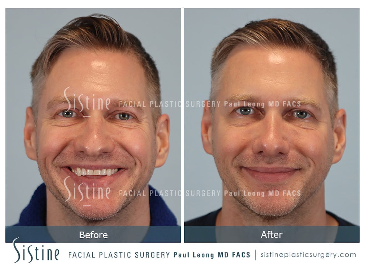 Rhinoplasty Before & After Gallery - Patient 103732 - Image 2