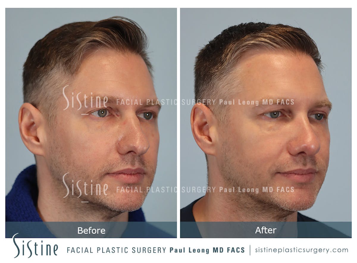 Rhinoplasty Before & After Gallery - Patient 103732 - Image 3