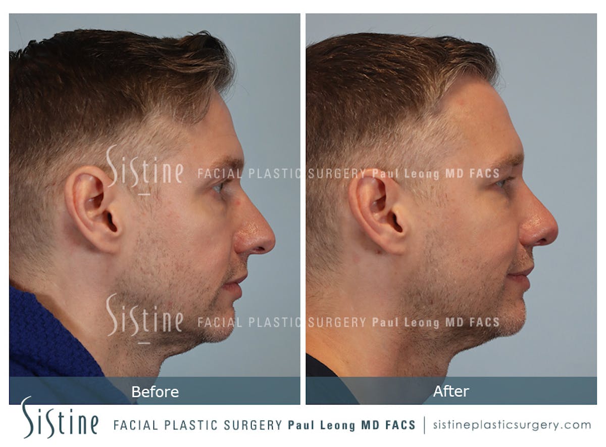 Rhinoplasty Before & After Gallery - Patient 103732 - Image 4
