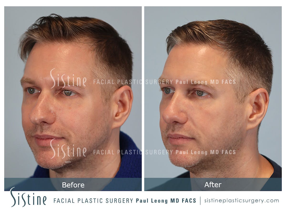 Rhinoplasty Before & After Gallery - Patient 103732 - Image 5