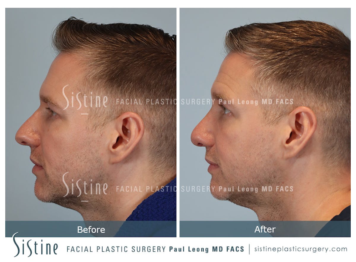 Rhinoplasty Before & After Gallery - Patient 103732 - Image 6