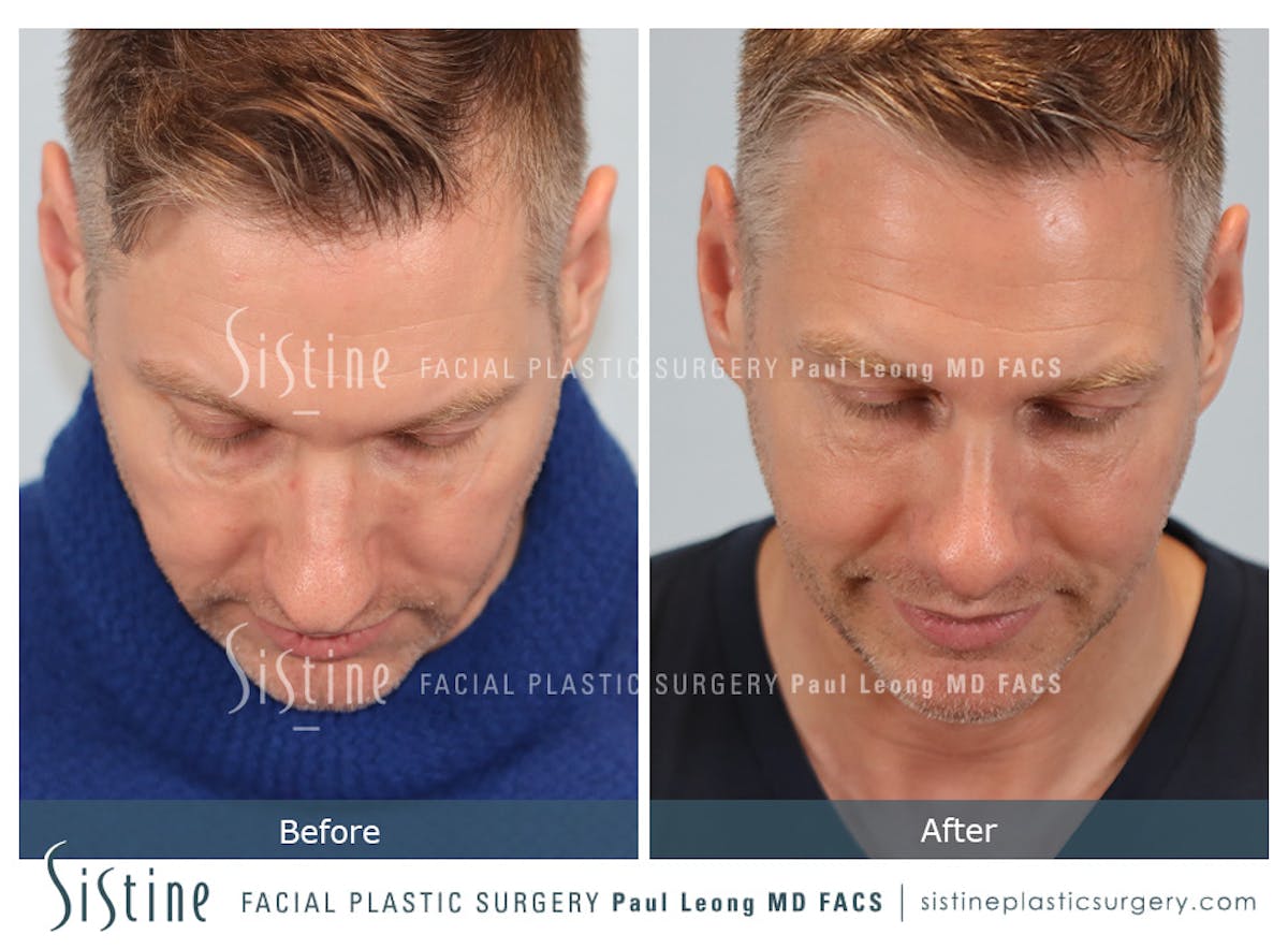 Rhinoplasty Before & After Gallery - Patient 103732 - Image 7