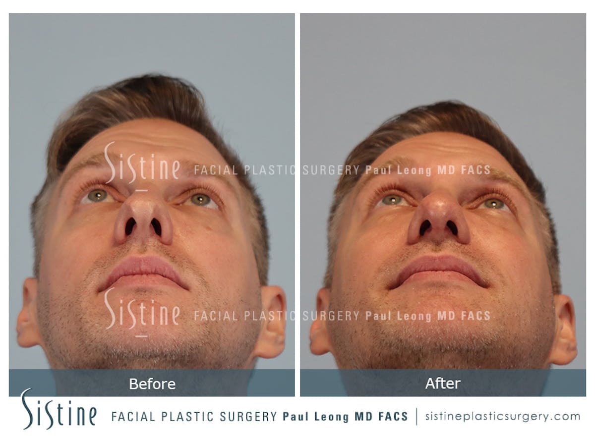 Rhinoplasty Before & After Gallery - Patient 103732 - Image 8