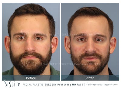 Rhinoplasty Before & After Gallery - Patient 133356 - Image 1