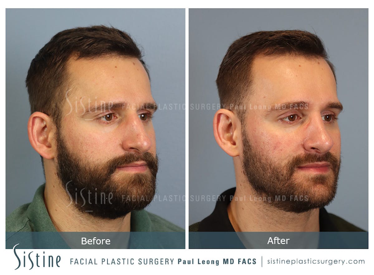 Rhinoplasty Before & After Gallery - Patient 133356 - Image 3