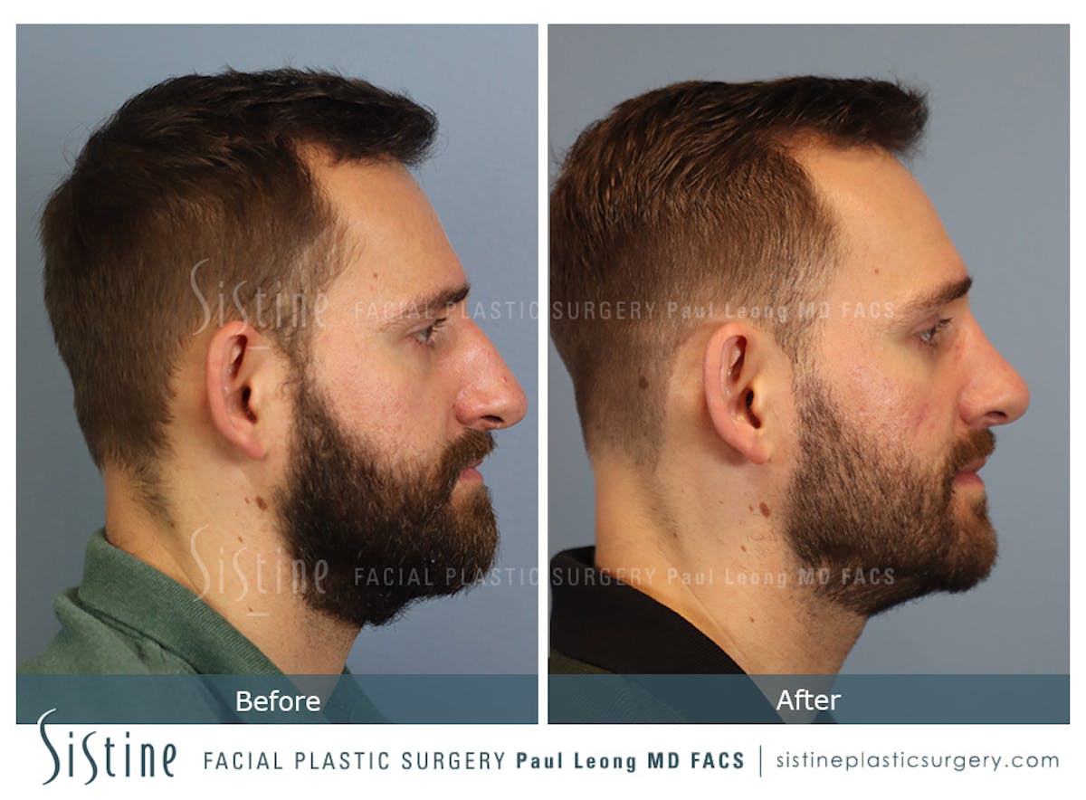 Rhinoplasty Before & After Gallery - Patient 133356 - Image 4