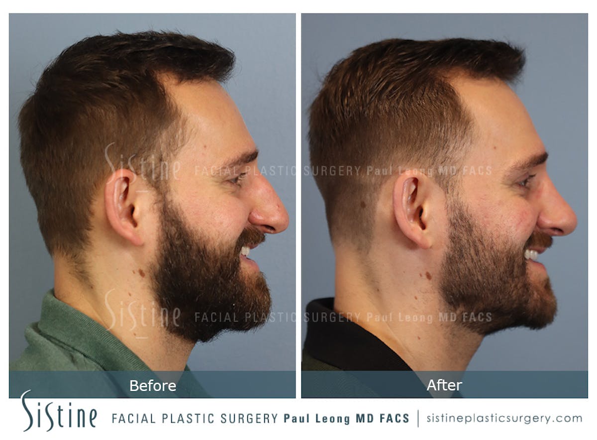 Rhinoplasty Before & After Gallery - Patient 133356 - Image 5
