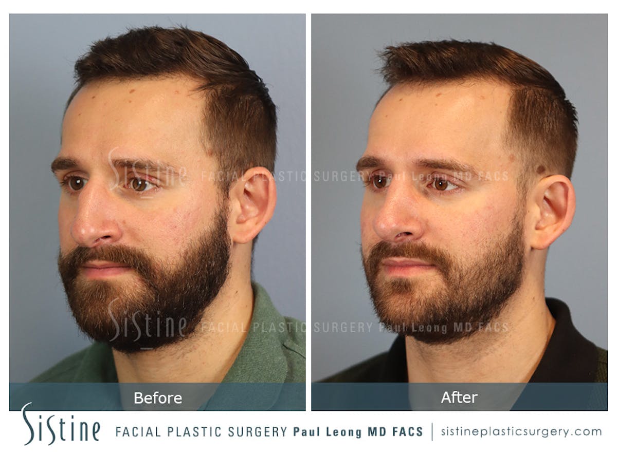 Rhinoplasty Before & After Gallery - Patient 133356 - Image 6