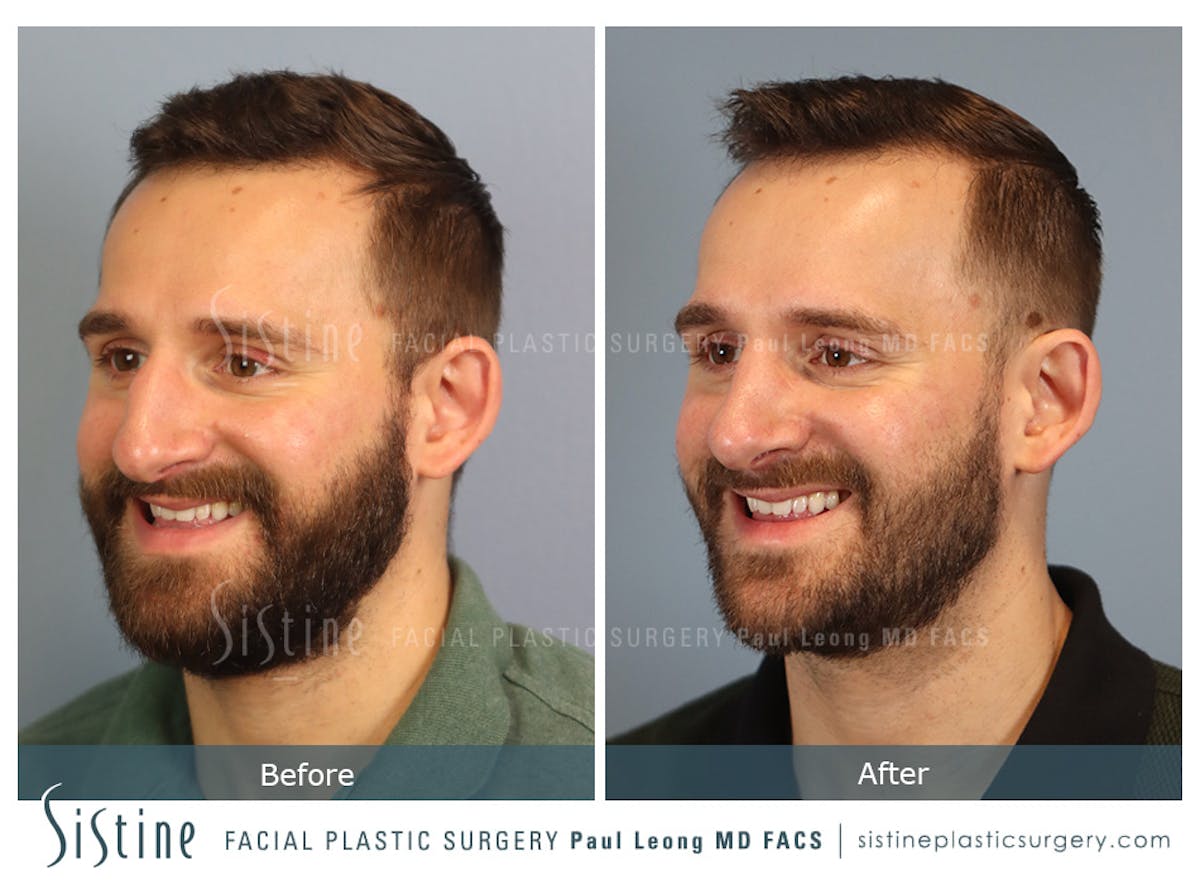 Rhinoplasty Before & After Gallery - Patient 133356 - Image 7