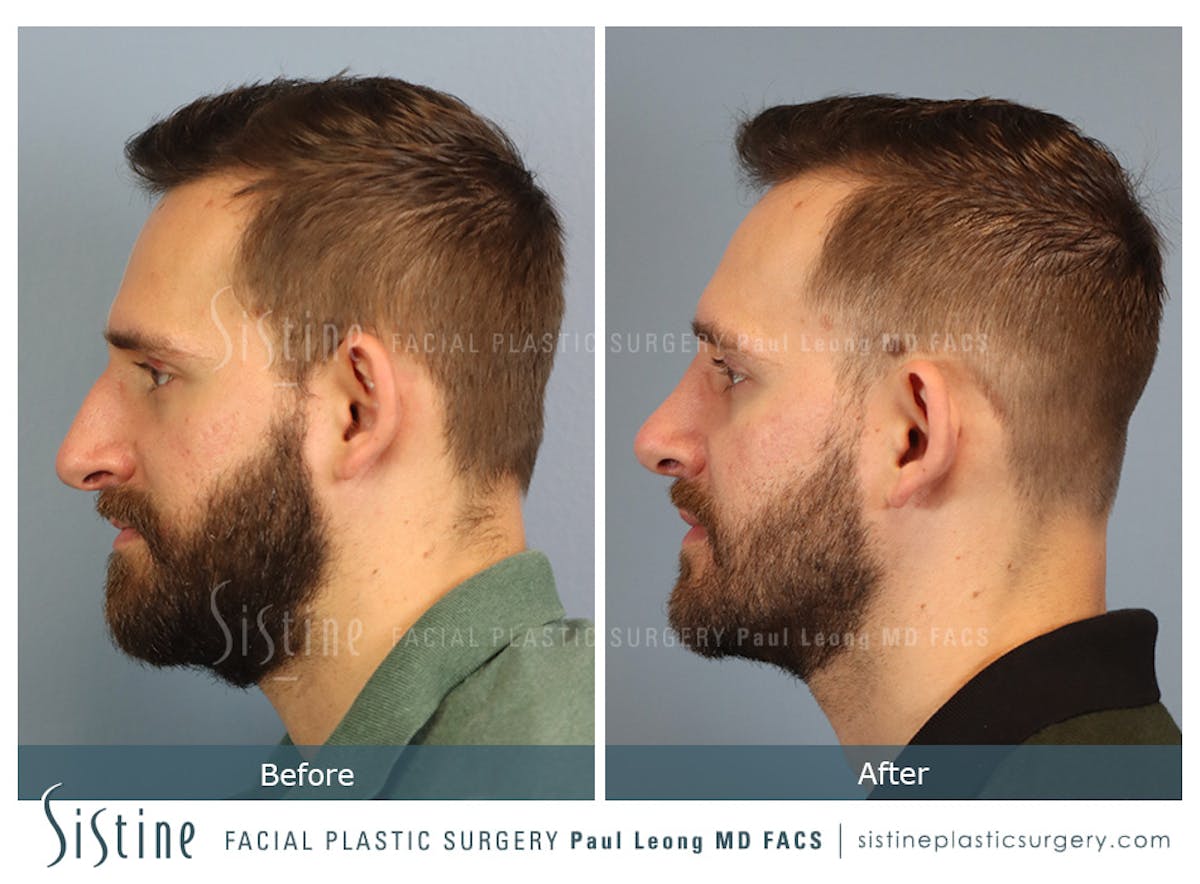 Rhinoplasty Before & After Gallery - Patient 133356 - Image 8