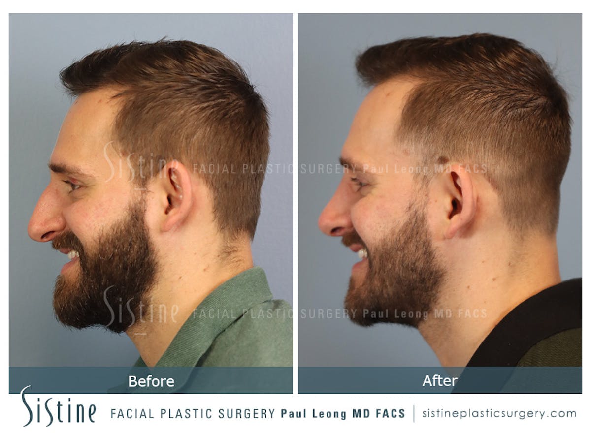 Rhinoplasty Before & After Gallery - Patient 133356 - Image 9