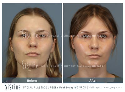 Rhinoplasty Before & After Gallery - Patient 237611 - Image 1