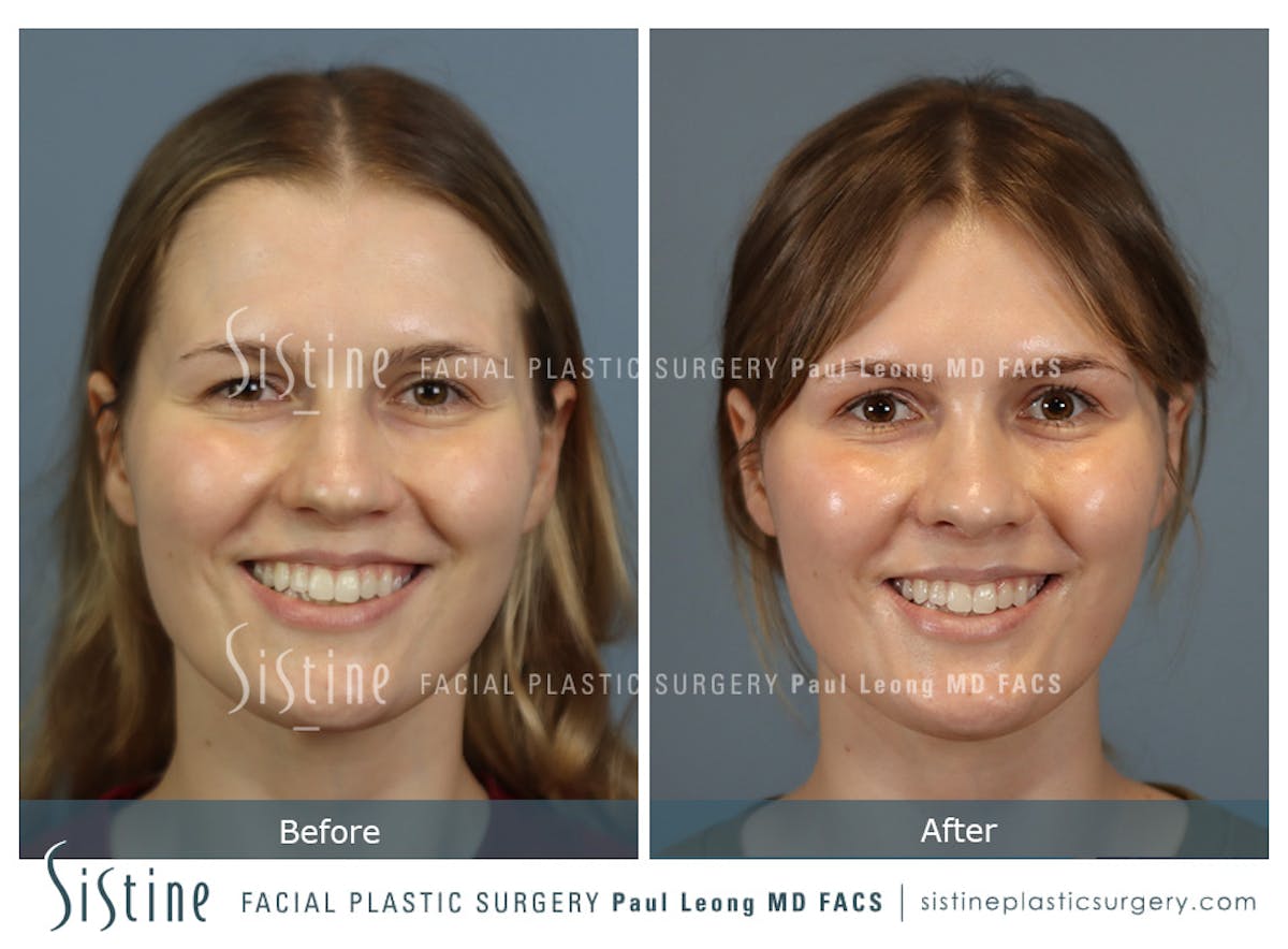 Rhinoplasty Before & After Gallery - Patient 237611 - Image 2