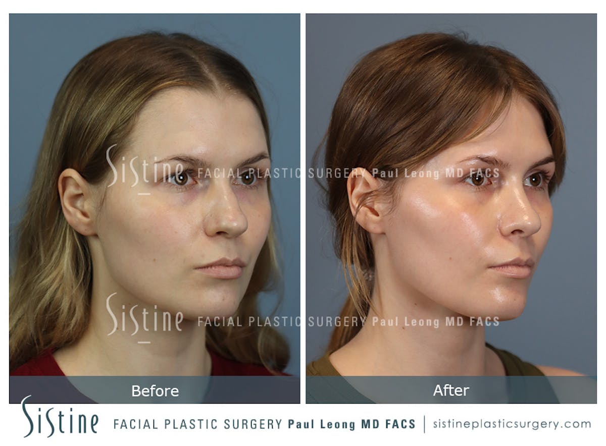 Rhinoplasty Before & After Gallery - Patient 237611 - Image 3