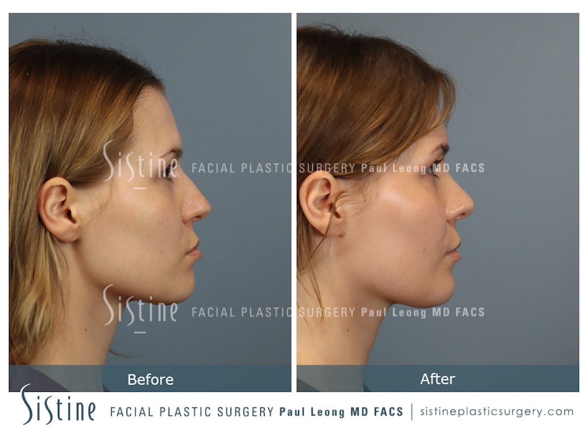 Rhinoplasty Before & After Gallery - Patient 237611 - Image 4