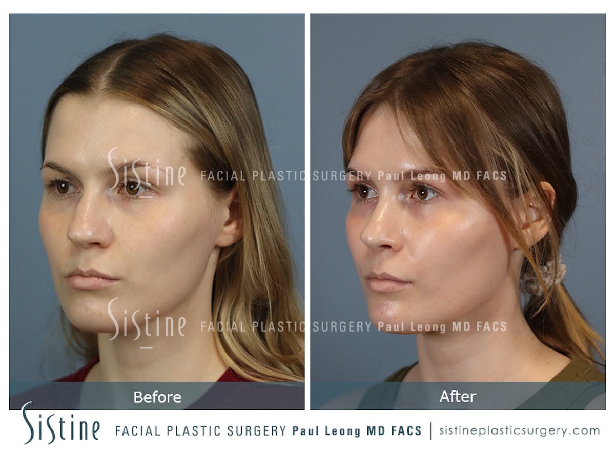 Rhinoplasty Before & After Gallery - Patient 237611 - Image 6