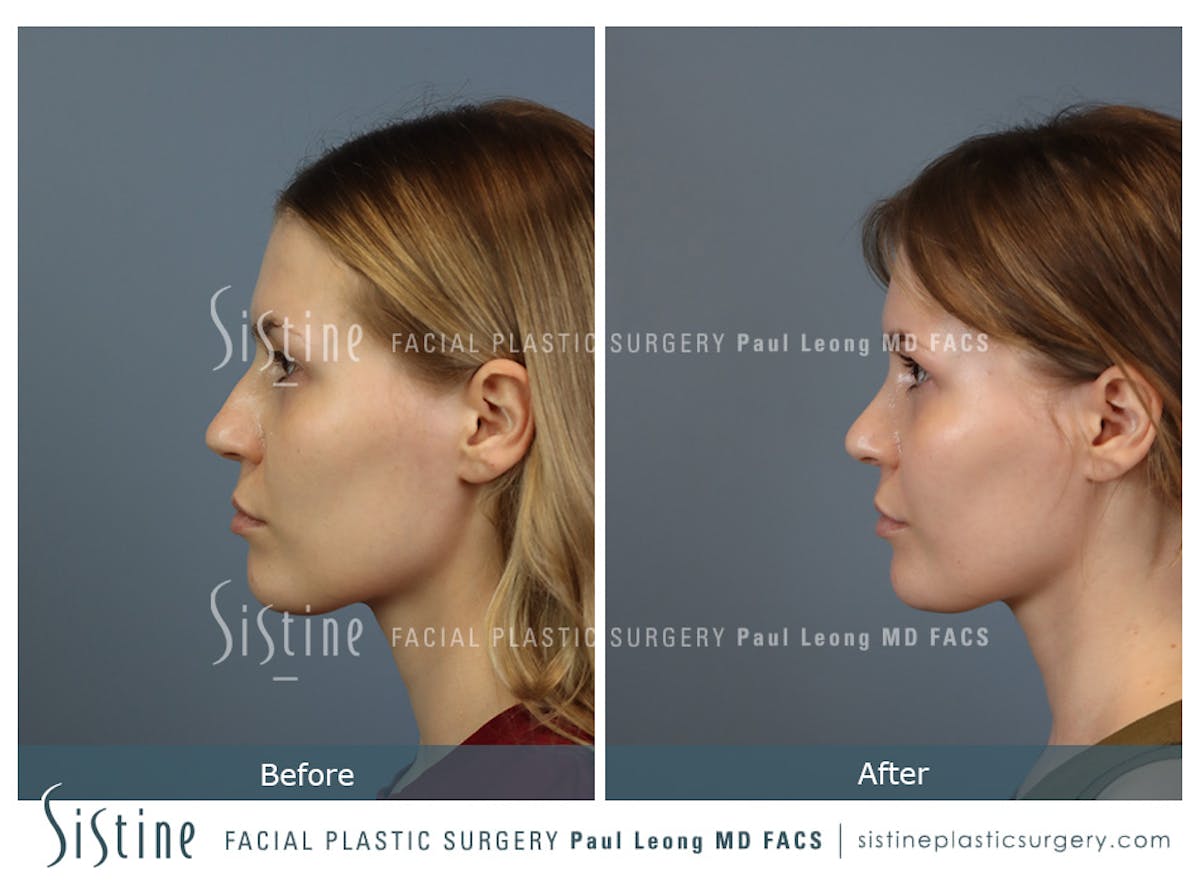 Rhinoplasty Before & After Gallery - Patient 237611 - Image 7