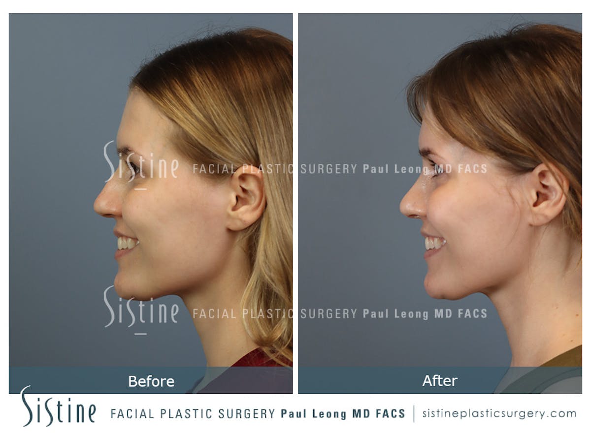 Rhinoplasty Before & After Gallery - Patient 237611 - Image 8