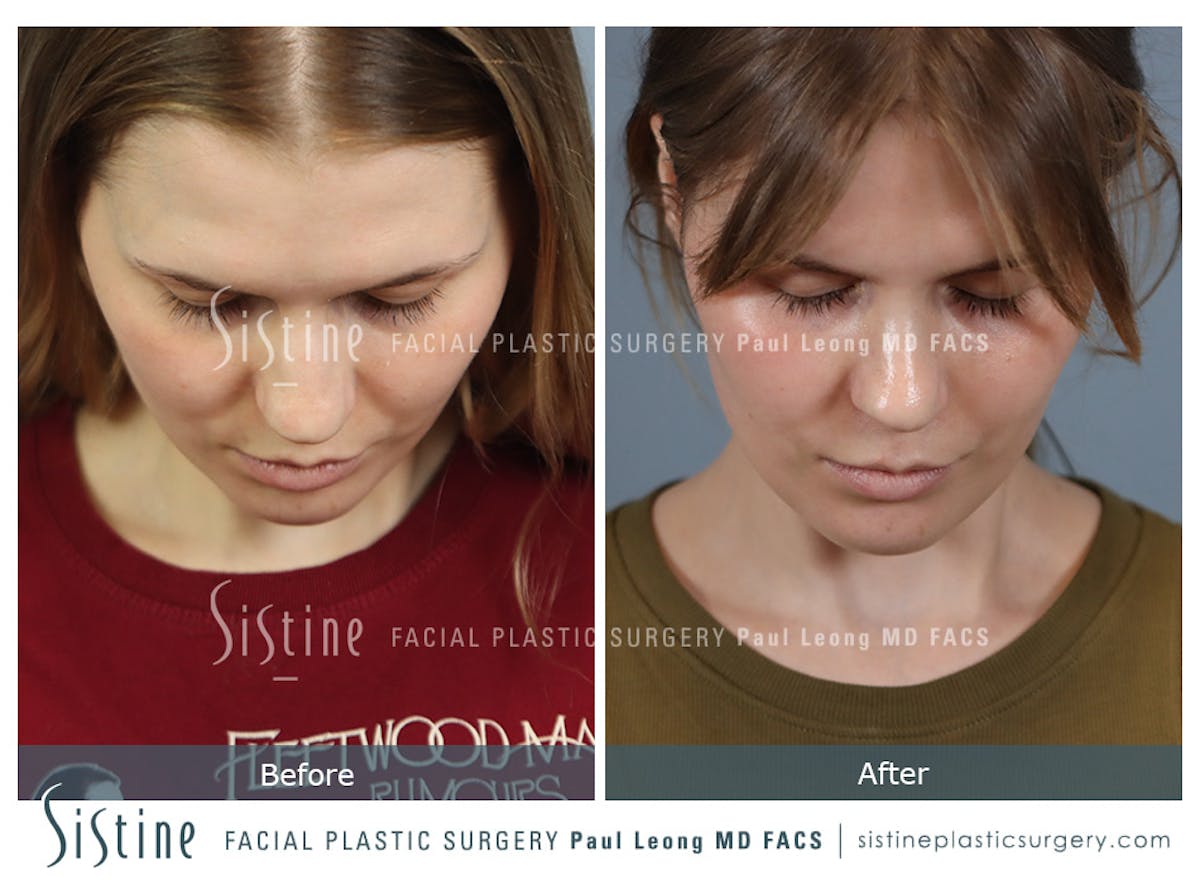 Rhinoplasty Before & After Gallery - Patient 237611 - Image 9