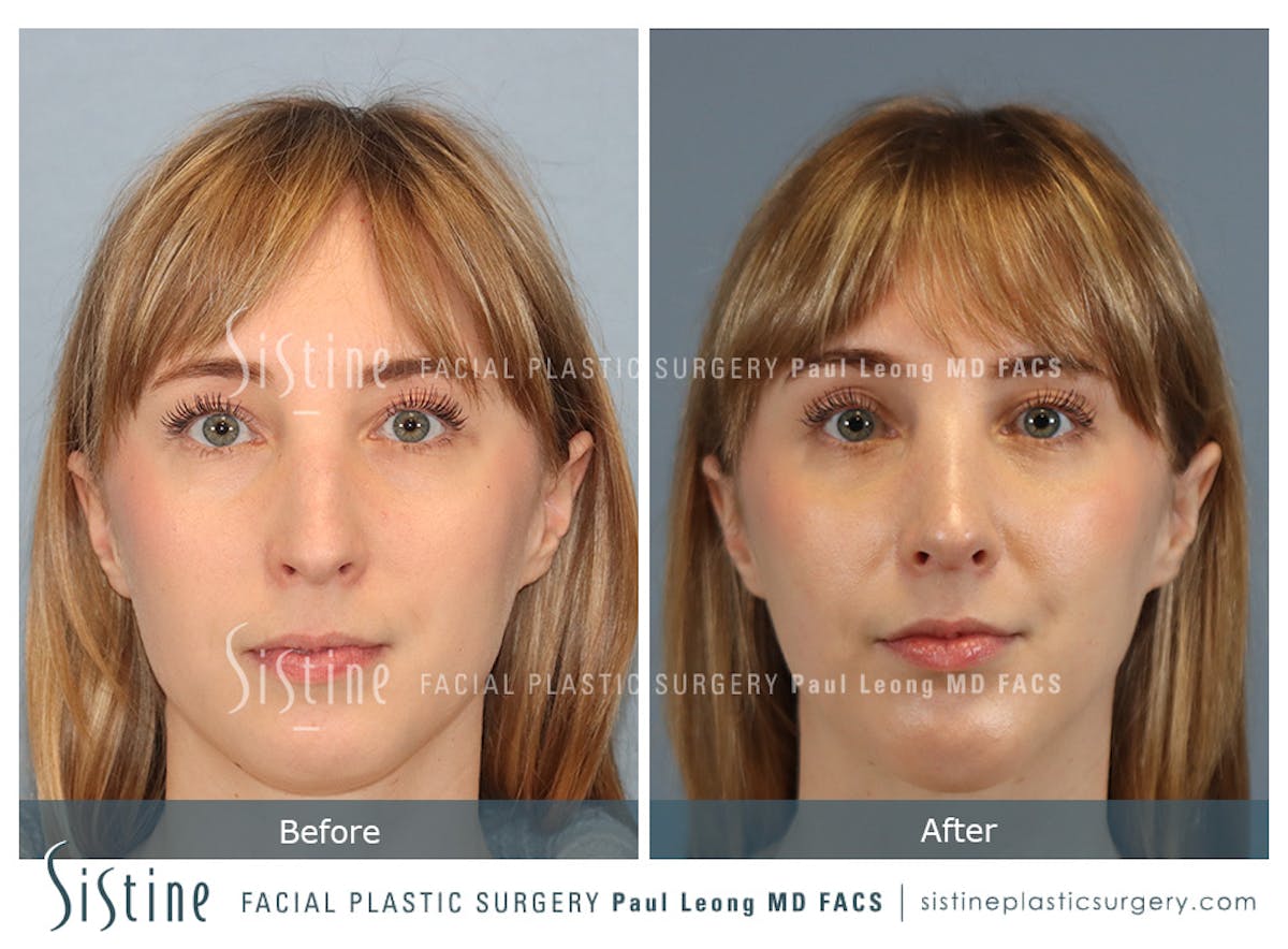 Rhinoplasty Before & After Gallery - Patient 427595 - Image 1