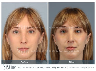 Rhinoplasty Before & After Gallery - Patient 427595 - Image 1