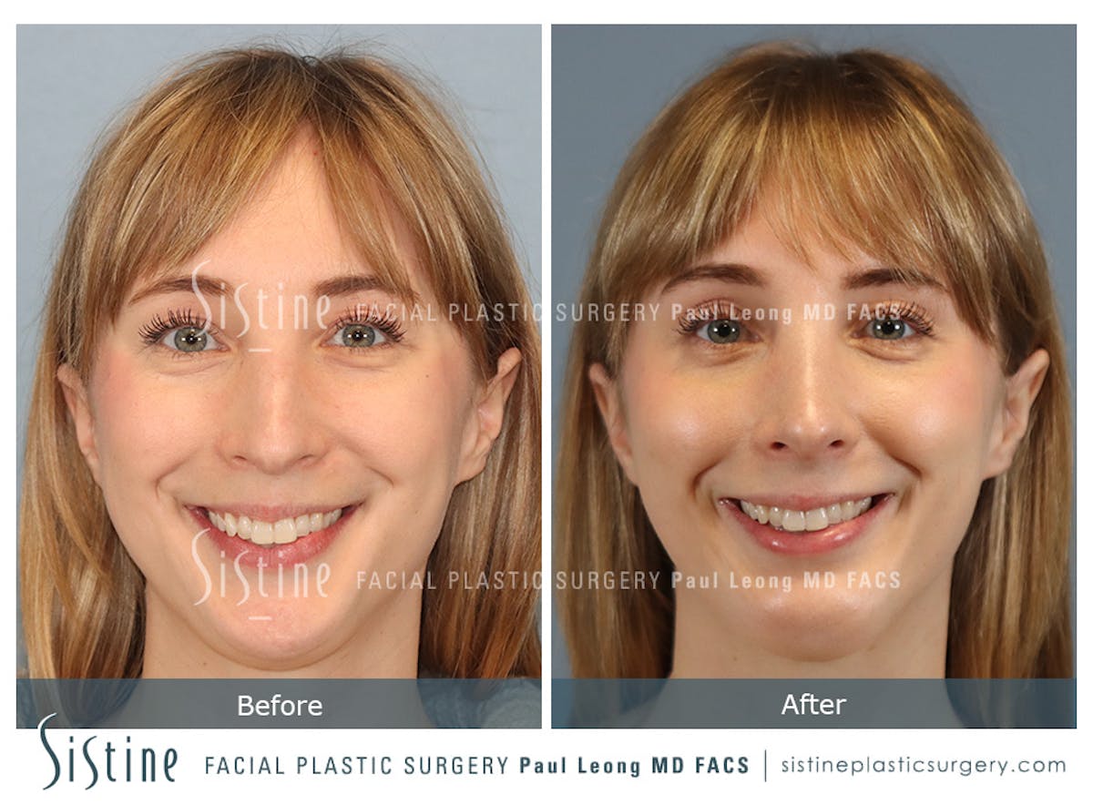 Rhinoplasty Before & After Gallery - Patient 427595 - Image 2