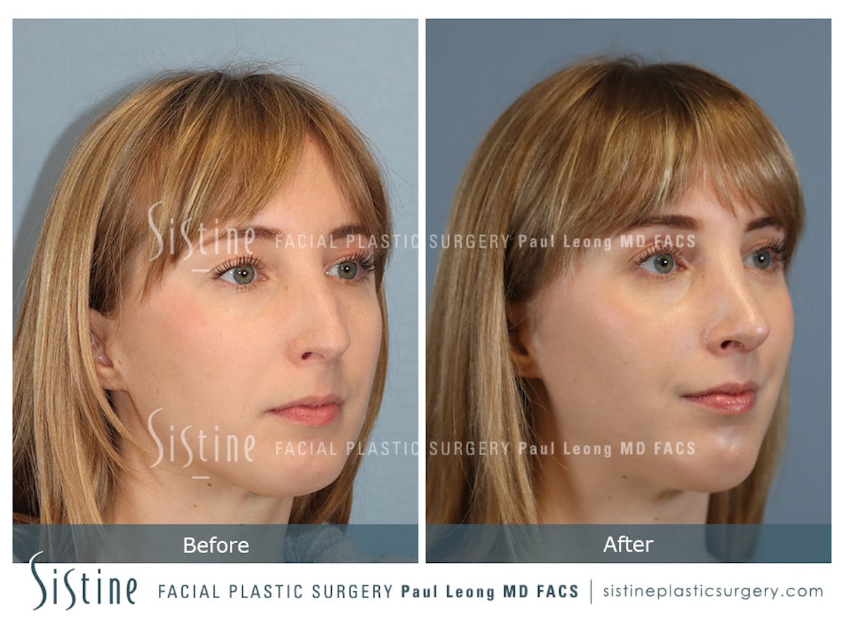 Rhinoplasty Before & After Gallery - Patient 427595 - Image 3