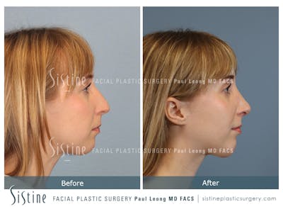 Chin Implant Before & After Gallery - Patient 384265 - Image 1