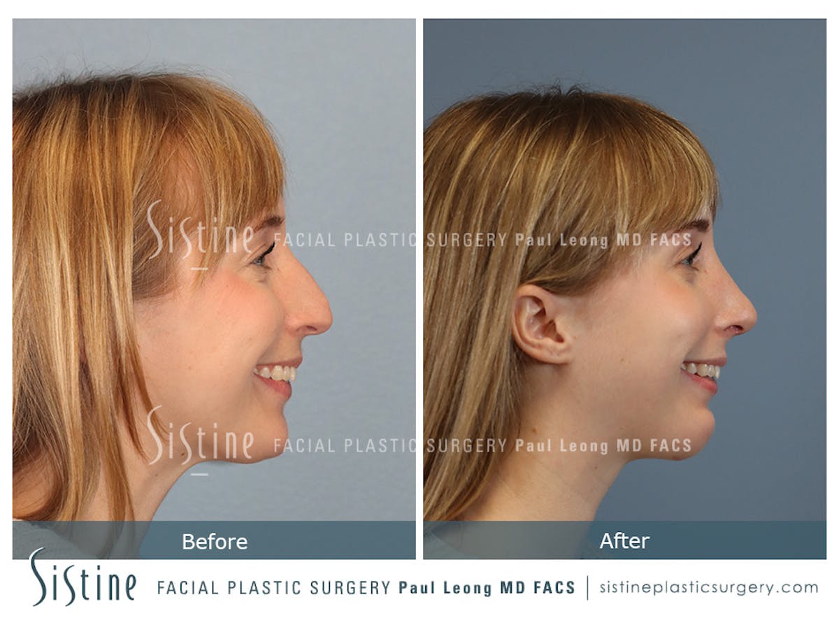 Rhinoplasty Before & After Gallery - Patient 427595 - Image 5