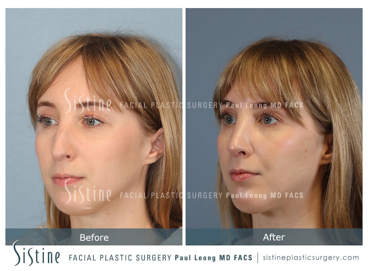 Rhinoplasty Before & After Gallery - Patient 427595 - Image 6