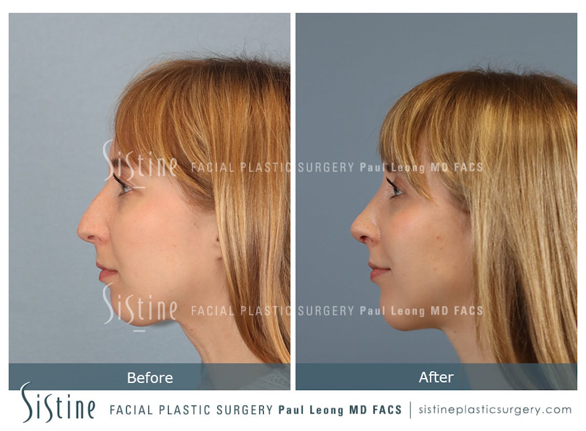 Rhinoplasty Before & After Gallery - Patient 427595 - Image 7