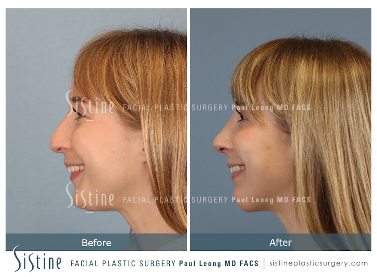 Rhinoplasty Before & After Gallery - Patient 427595 - Image 8
