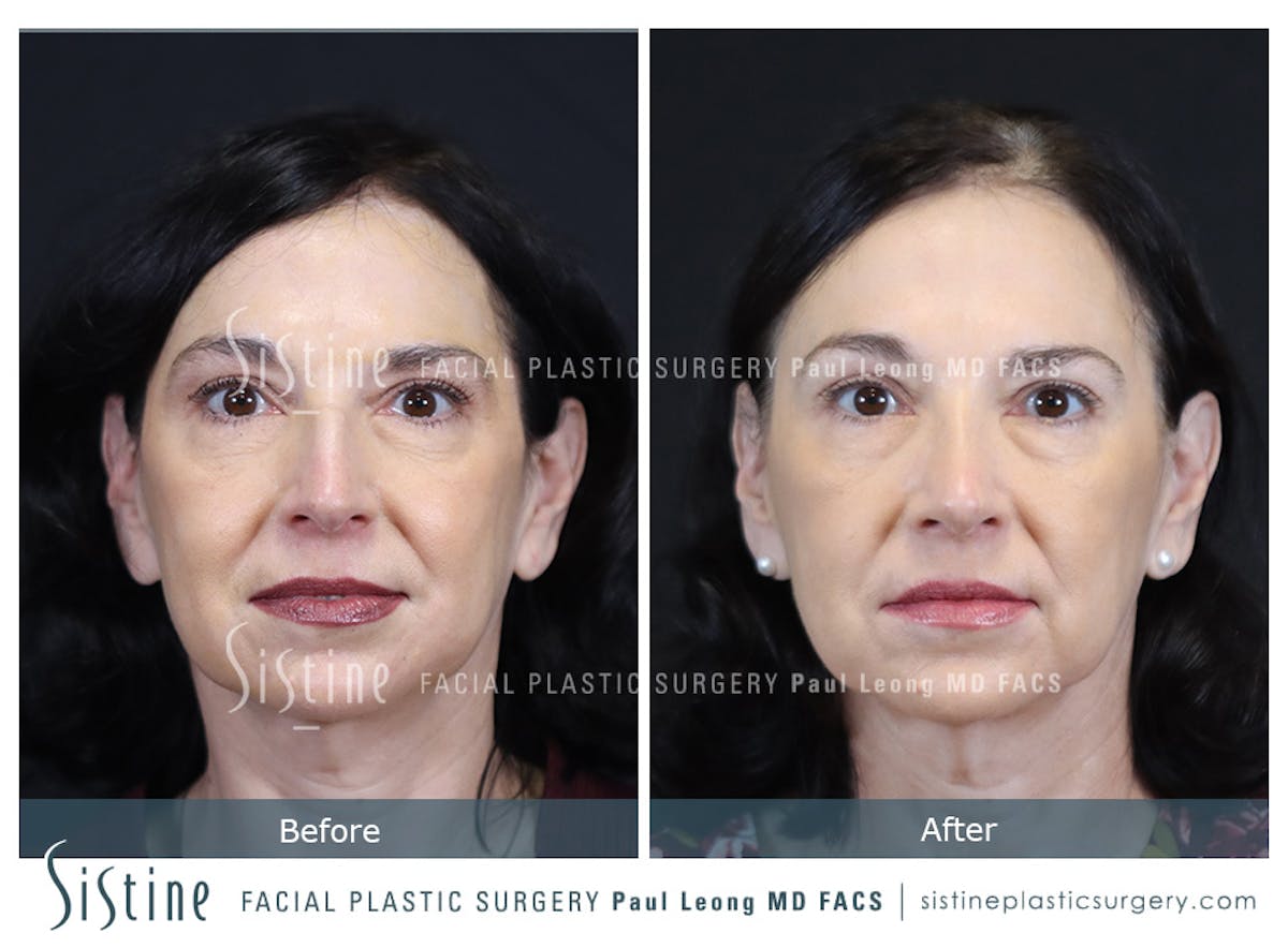 Rhinoplasty Before & After Gallery - Patient 393037 - Image 1