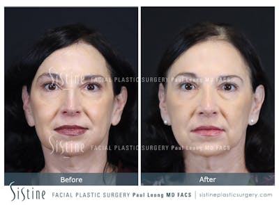 Rhinoplasty Before & After Gallery - Patient 393037 - Image 1